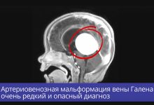 Фото - Опасный варикоз в мозге удалили семимесячному младенцу нейрохирурги из Новосибирска