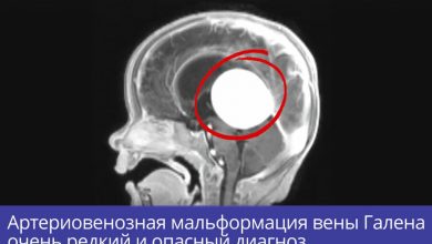 Фото - Опасный варикоз в мозге удалили семимесячному младенцу нейрохирурги из Новосибирска