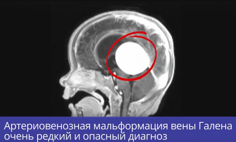 Фото - Опасный варикоз в мозге удалили семимесячному младенцу нейрохирурги из Новосибирска